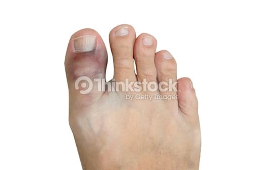 Broken toe: Treatments, symptoms, pictures, and healing time