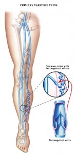 Varicose Veins