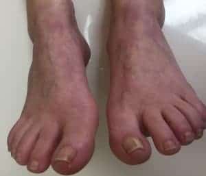 Livedo Reticularis Or What Is The Weird Blue Pattern On My Feet Beaver Valley Foot Clinic