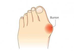 Myths About Bunion - Beaver Valley Foot Clinic