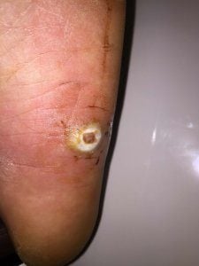 cellulitis toe