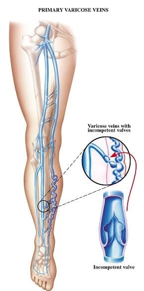 Varicose Vein Surgical Removal  Medilaser  Frisco TX