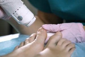 Fungus Toenails laser