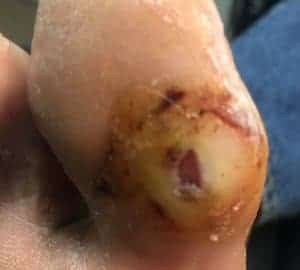 Diabetic Foot Ulcer