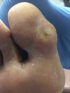 Diabetic Foot Ulcer