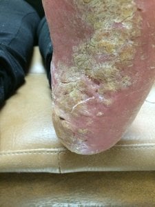 Do I have Psoriasis? - Beaver Valley Foot Clinic