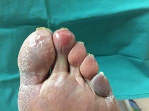 raynauds disease