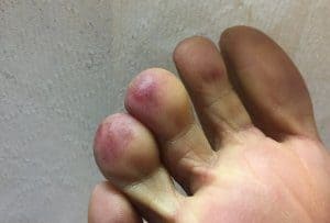 Raynaud's Syndrome and Chilblains Treatment - Beaver Valley Foot