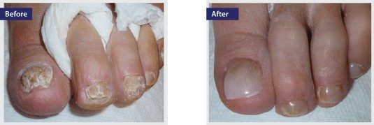 keryflex fake nail