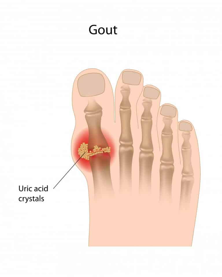 krystexxa gout