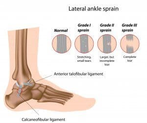 ankle sprain treatment center township