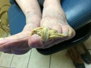 Foot Fungus 