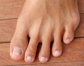 infected ingrown toenails