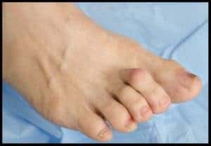 Hammertoe symptoms Cranberry Twp