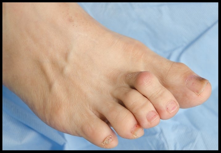 Mallet Toe Vs Hammer Toe