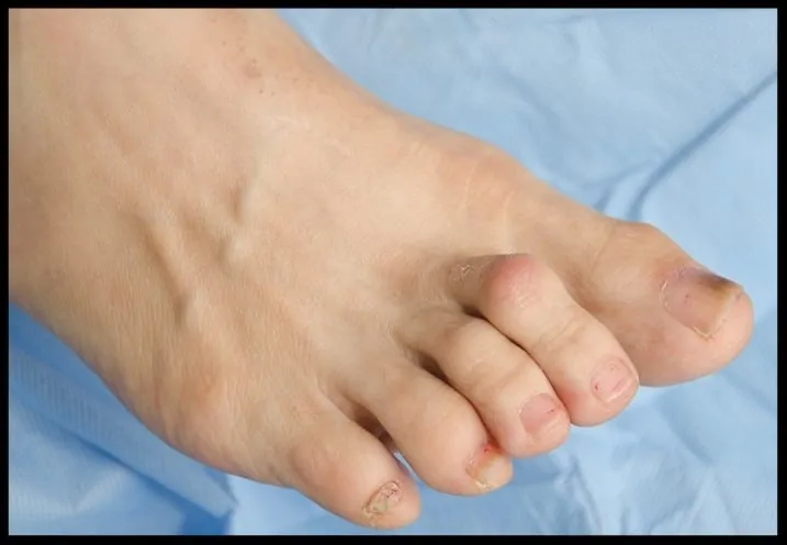 crooked toes crooked toes
