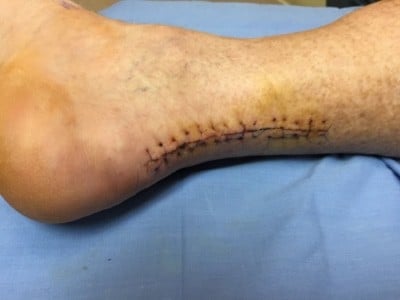 Arsenal star Santi Cazorla almost lost foot to gangrene  Daily Mail Online