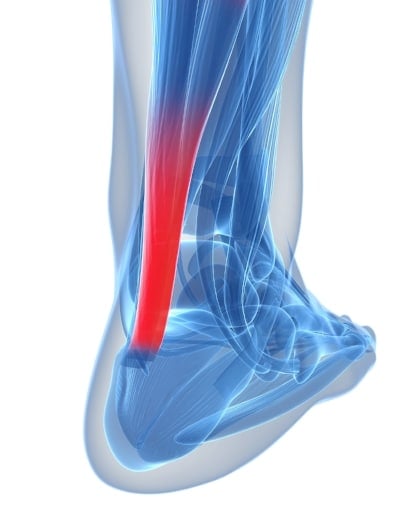 Achilles Tendonitis