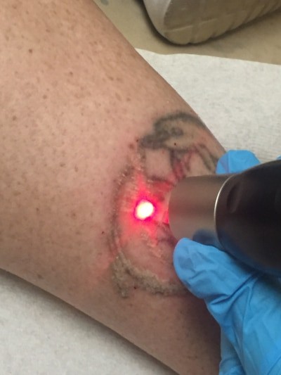 Removing a Leg Tattoo