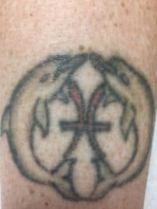 laser tattoo removal Cranberry