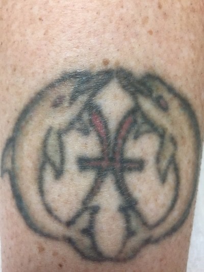 tattoo removal laser