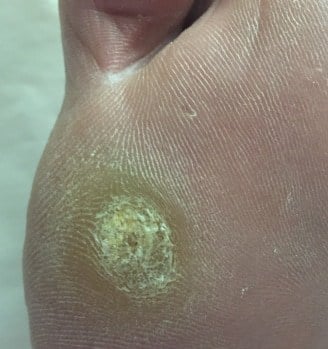 Plantar wart treatment