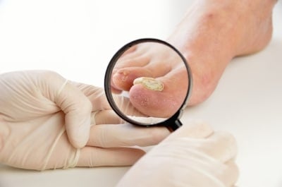 The Dangers of Ingrown Toenails: Washington Foot & Ankle Sports Medicine:  Podiatry