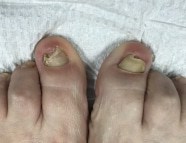 artificial Toenails before