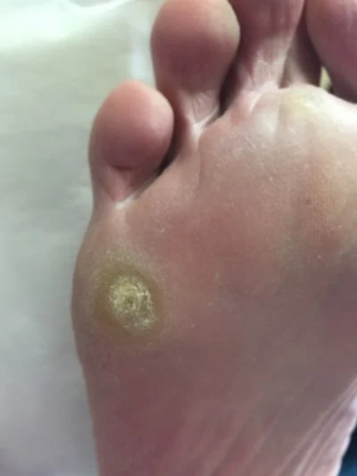 best treatment for callus on bottom of feet