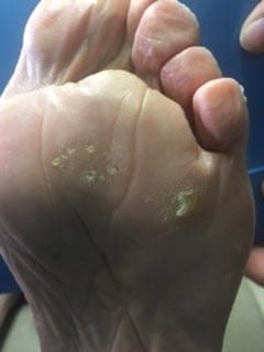 multiple corns on foot