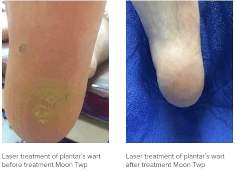 Laser treatment of plantar’s wart treatment Moon Twp 