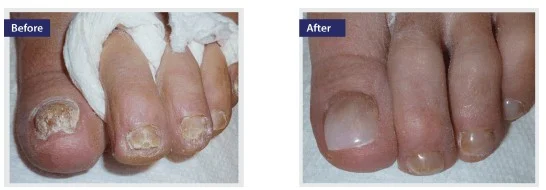 Keryflex Artificial Toenail pittsburgh 