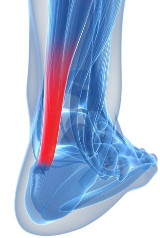 Achilles Tendon Treatment Pittsburgh