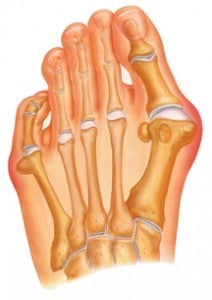 bunion treatment center twp pa