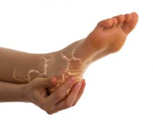 Restless Leg Syndrome Treatment Beaver Valley Foot Clinic