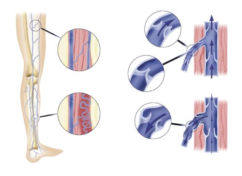 Varicose and spider vein treatments pittsburgh