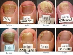 before and after pictures laser toenail fungus treatment 