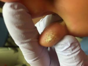 Treatment of Plantar Warts Pittsburgh 