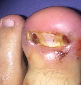 infected toenail treatment