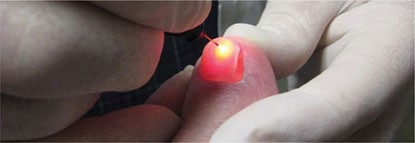 Toenail Fungus treated with Laser Cranberry Twp Pa