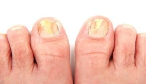 toenail polish fungus