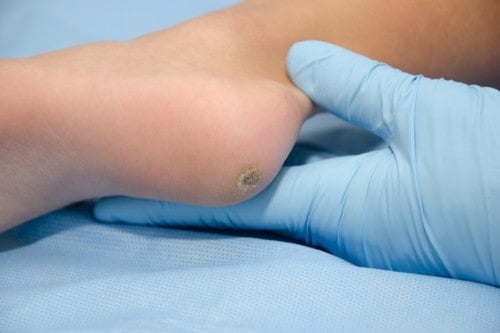 Plantar Wart Treatment With Lasers For Wart Removal Bvfc