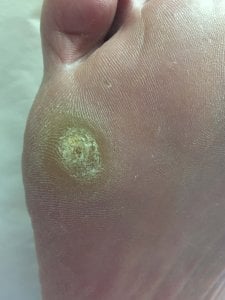 Plantar Warts treatment in Pittsburgh 