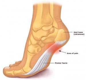 Minimalist shoes store and plantar fasciitis