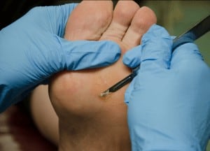 Plantar callus removal: how to get rid of calluses on feet permanently?