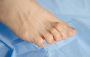 Crooked Toes and Hammertoes - Beaver Valley Foot Clinic