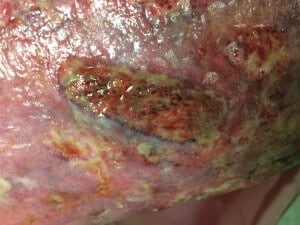 beforestrano-300x225 Venous Stasis Leg Ulcer Bridgewater Pa