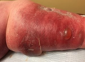 leg blister treatment Pittsburgh