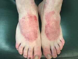 5 Natural Eczema on Feet Treatments