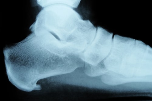 sports injury heel spur pittsburgh 